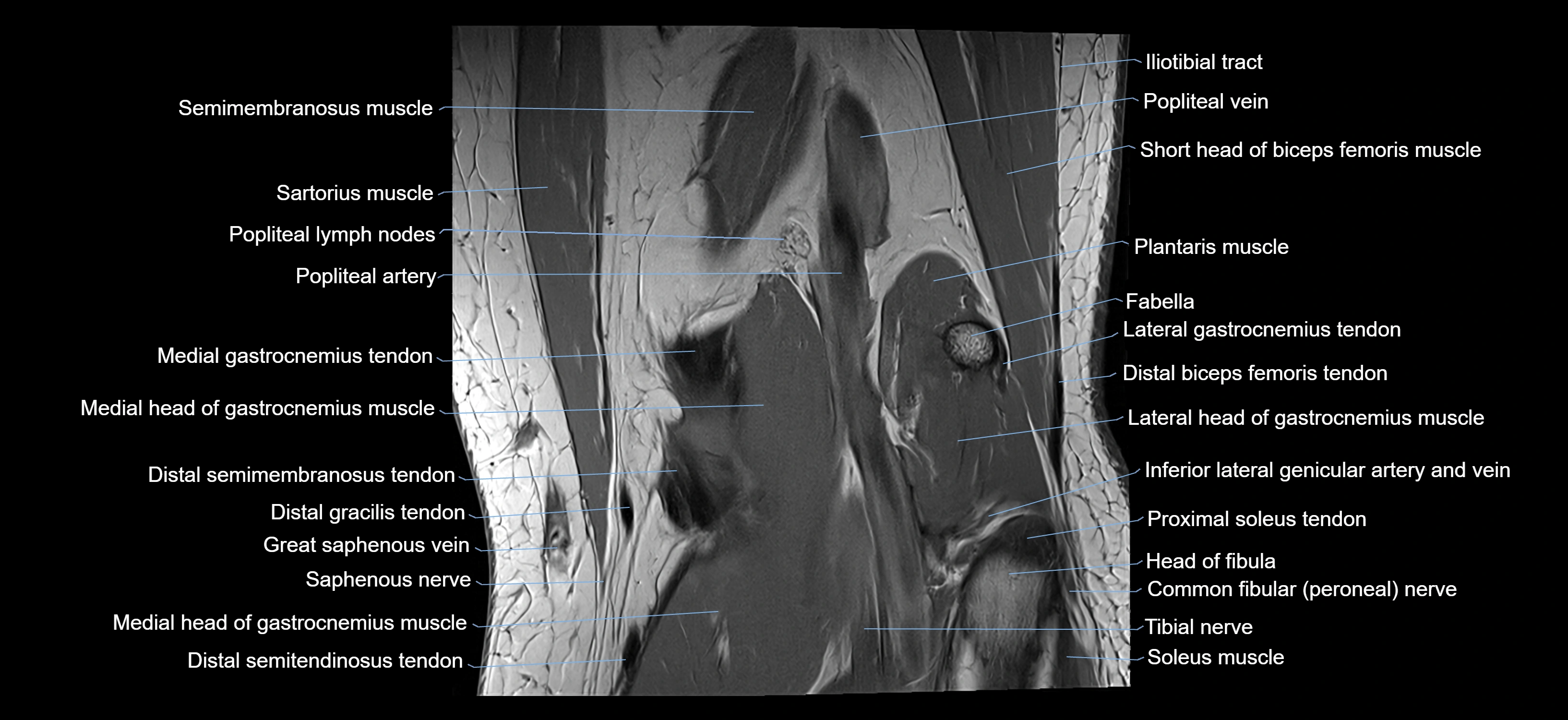 MRI knee coronal cross sectional anatomy labelled 3T radiology  image-04001-00031.webp